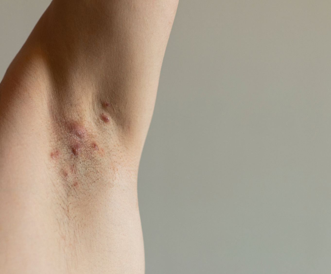 hidradenitis suppurativa on underarm