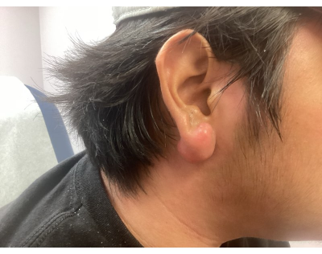 A side view of an earlobe showing a smooth, firm, flesh-toned bump at the site of a piercing.