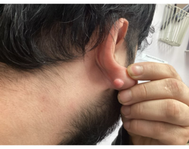 A person holding their earlobe to show a small, smooth, skin-colored bump on the back of the lobe.