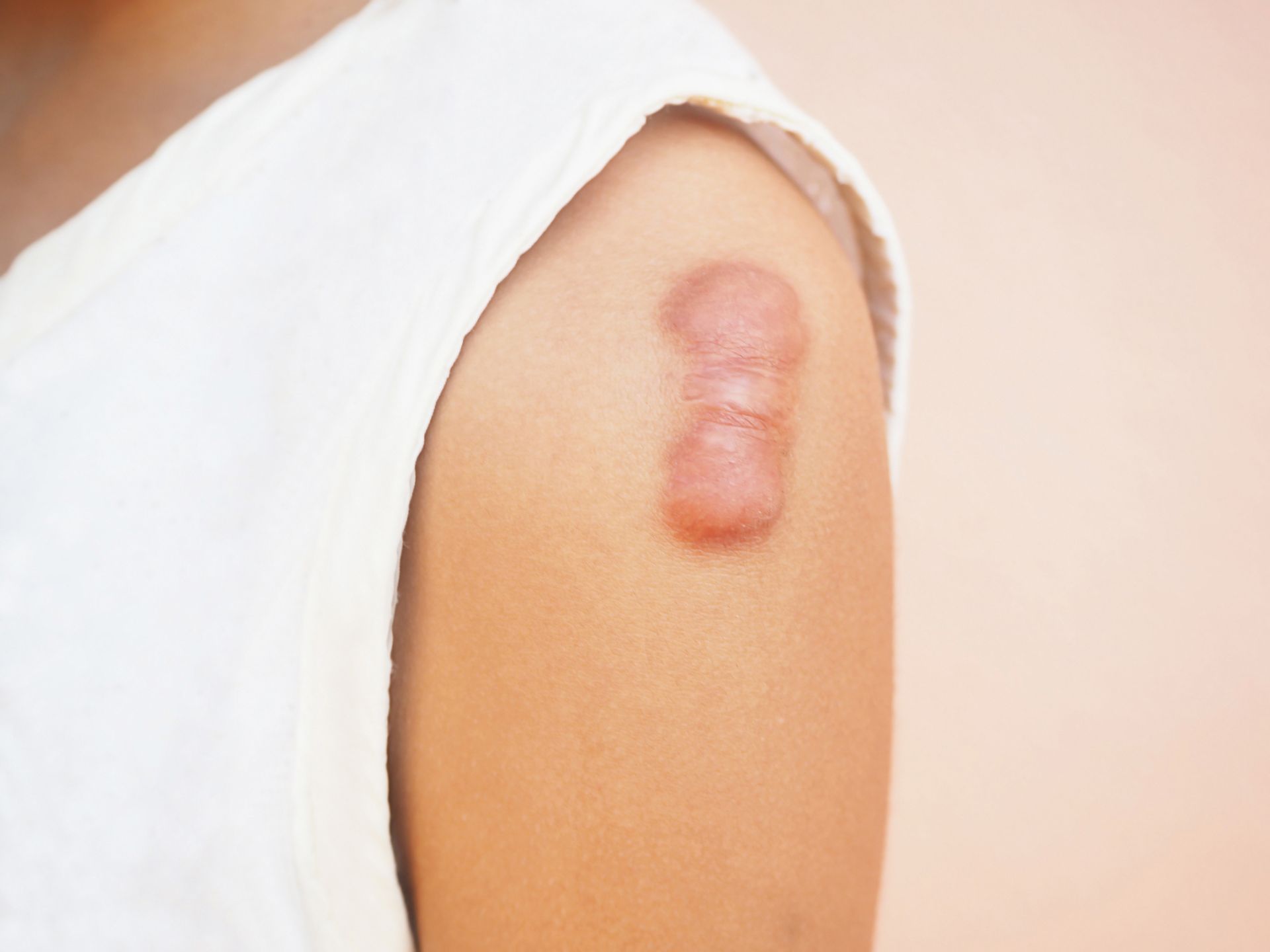 closeup of large keloid scar on white female patient's shoulder