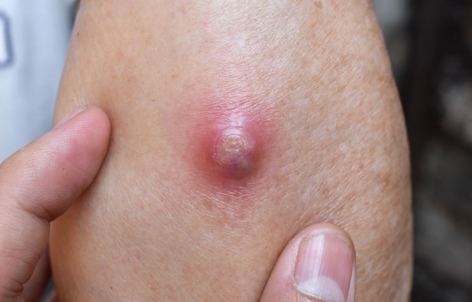 enlarged abscess on white male patient's arm