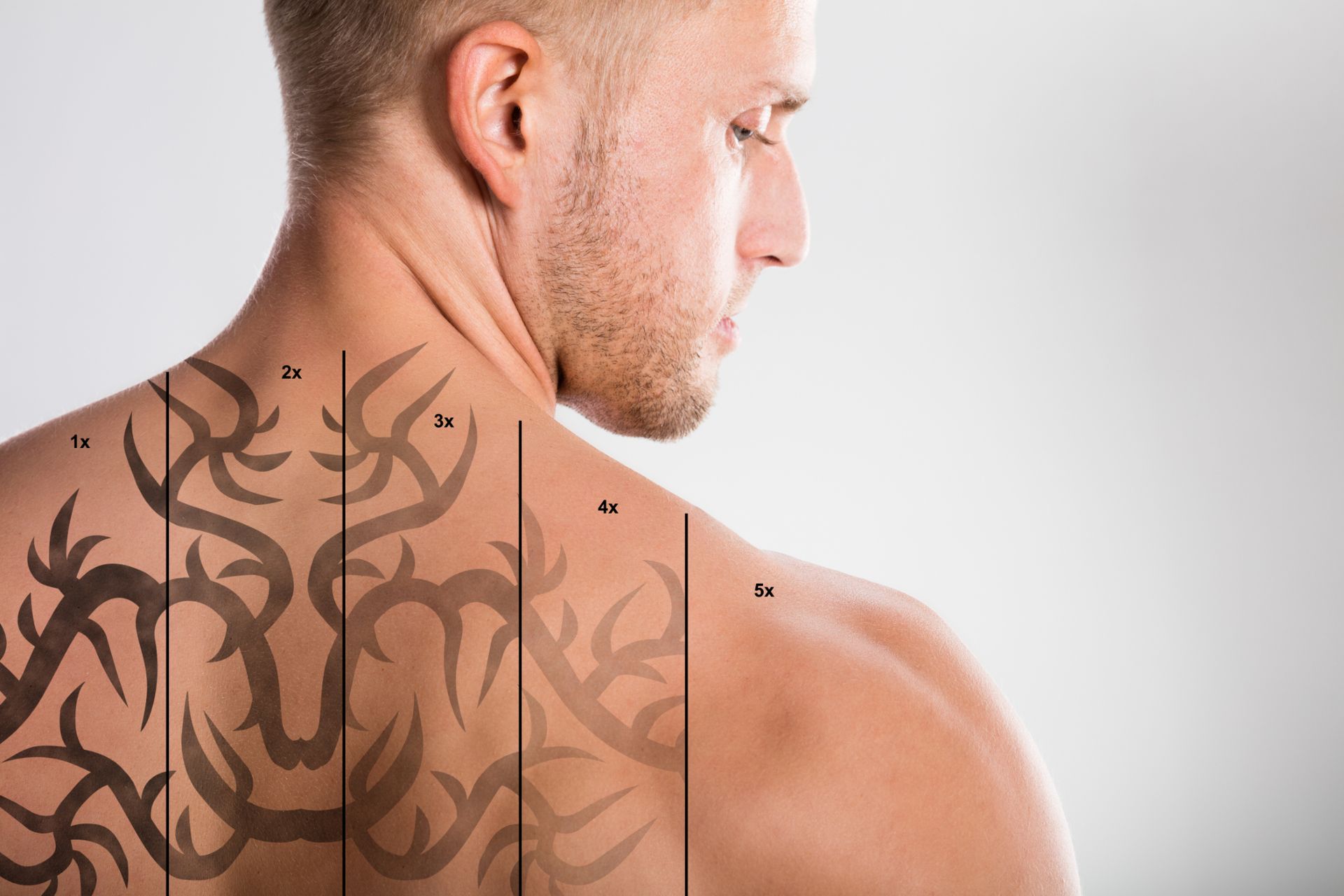 laser tattoo removal progression on white male patient's back