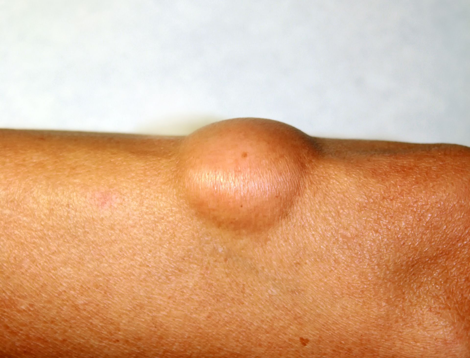 closeup of lipoma
