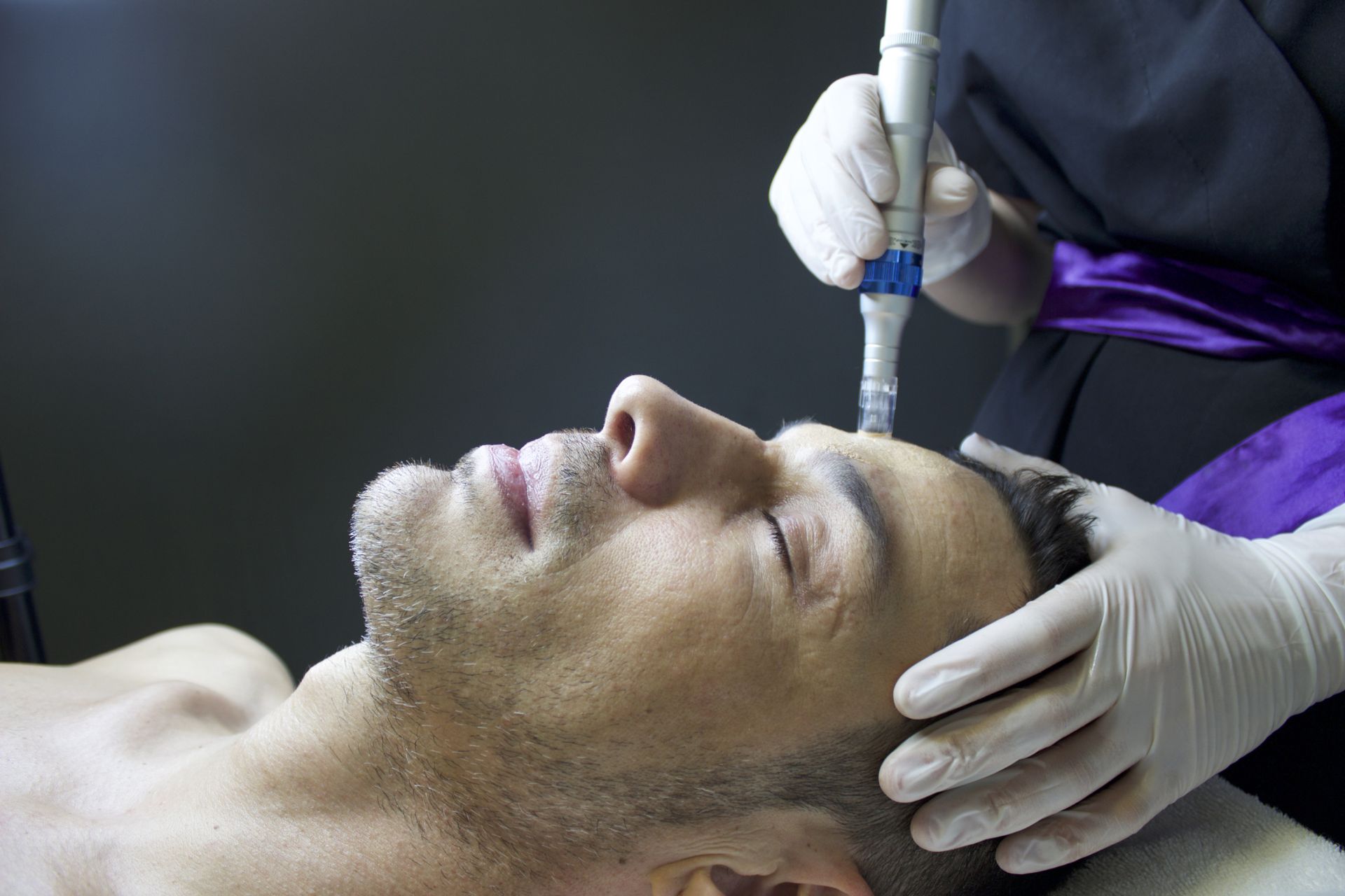 closeup of microneedling facial treatment on middle-age white male
