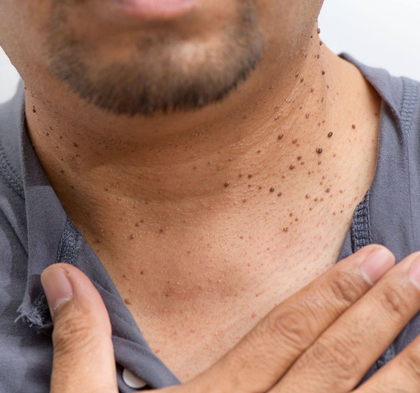 hispanic male patient with skin tags on neck