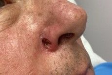 Close-up of a person's nose showing a lesion on the edge of the nostril opening.