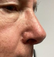 Close-up, side profile view of a person's nose and eye area showing skin texture and features.