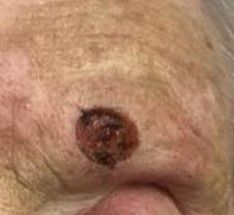 A brown, irregularly shaped lesion on fair-toned, textured skin.