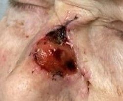 A close-up of a nose with an ulcerated, reddish-brown lesion and visible sutures along the side.