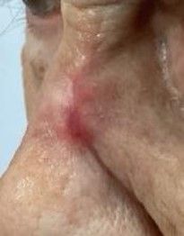 A close-up view of a red, raised, and slightly textured lesion on the side of a person’s nose.
