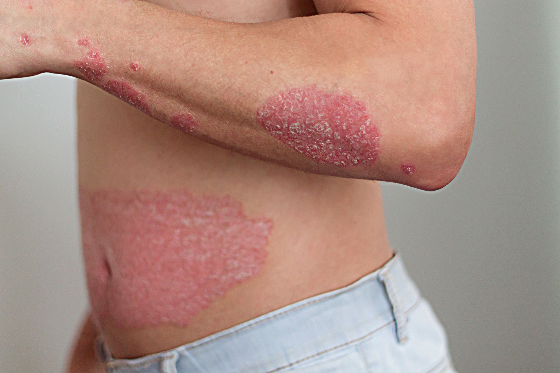 psoriasis lesions on white male patient's forearm and stomach