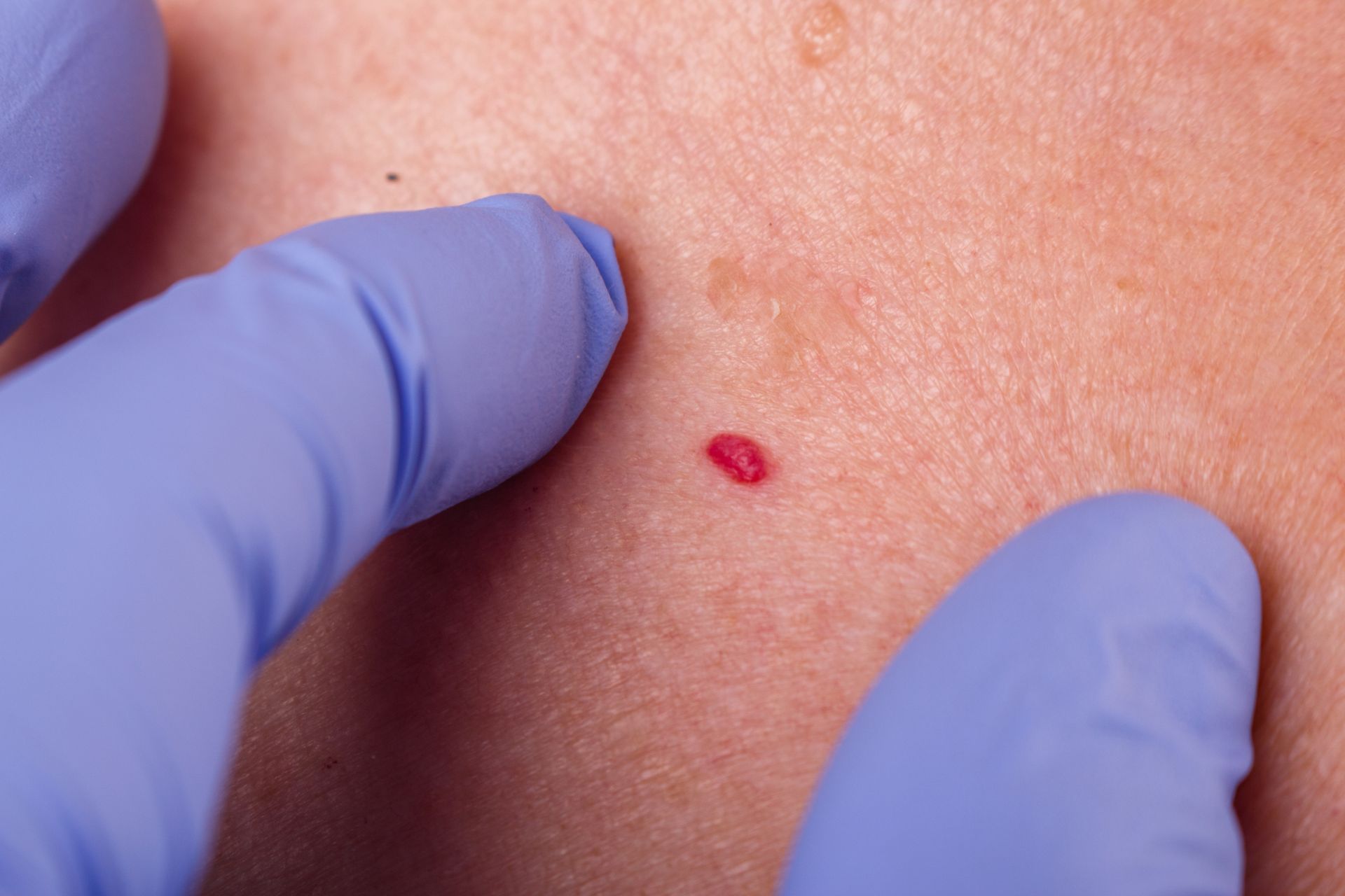 closeup of cherry angioma on patient's back