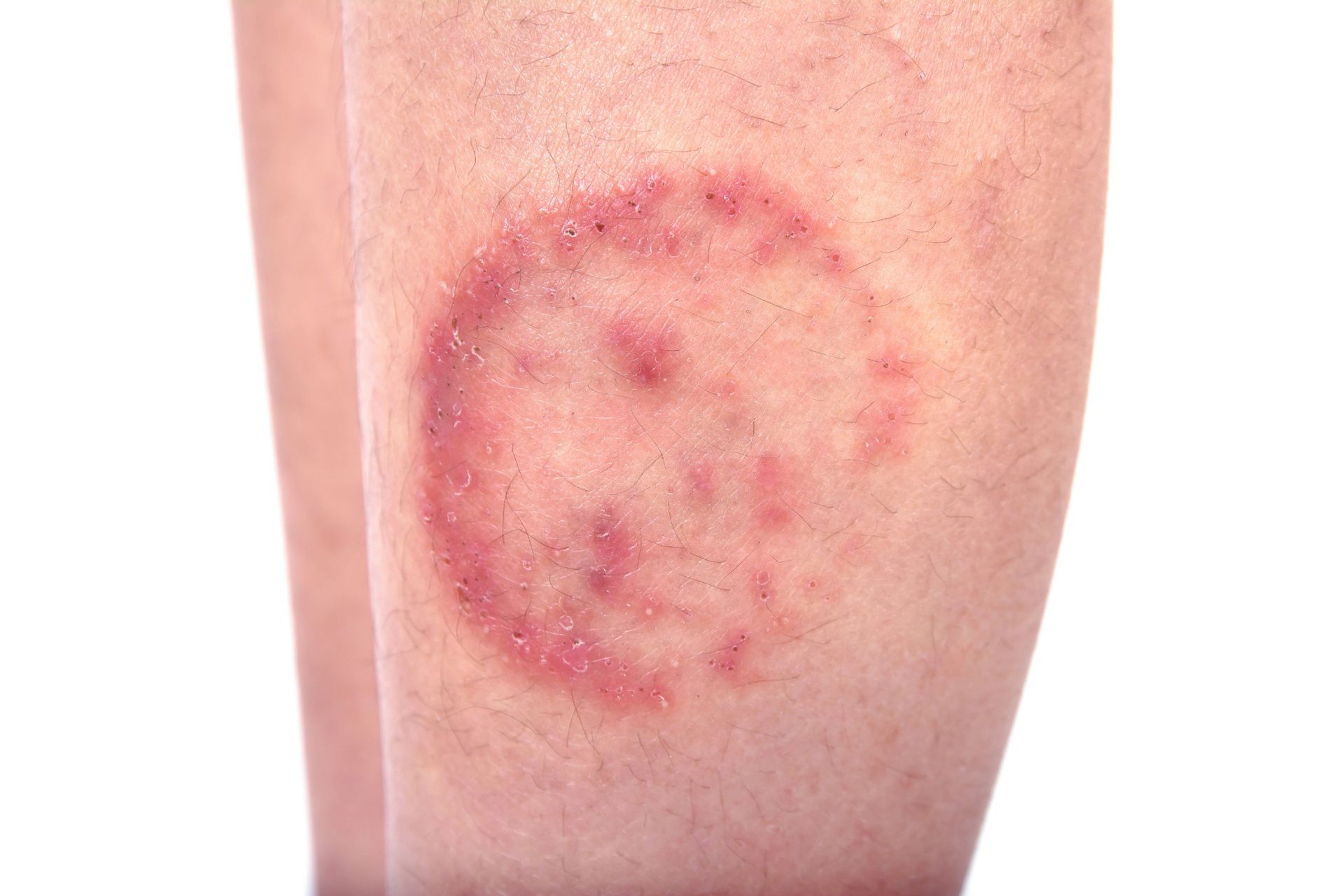 closeup of ringworm rash on white patient's leg