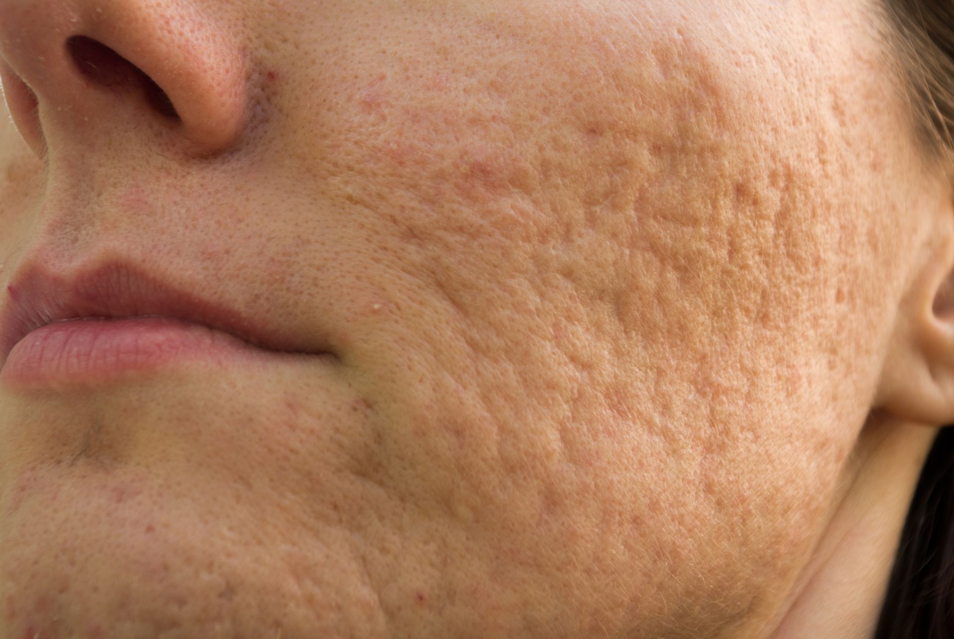 A close up of a woman 's face with acne on it.