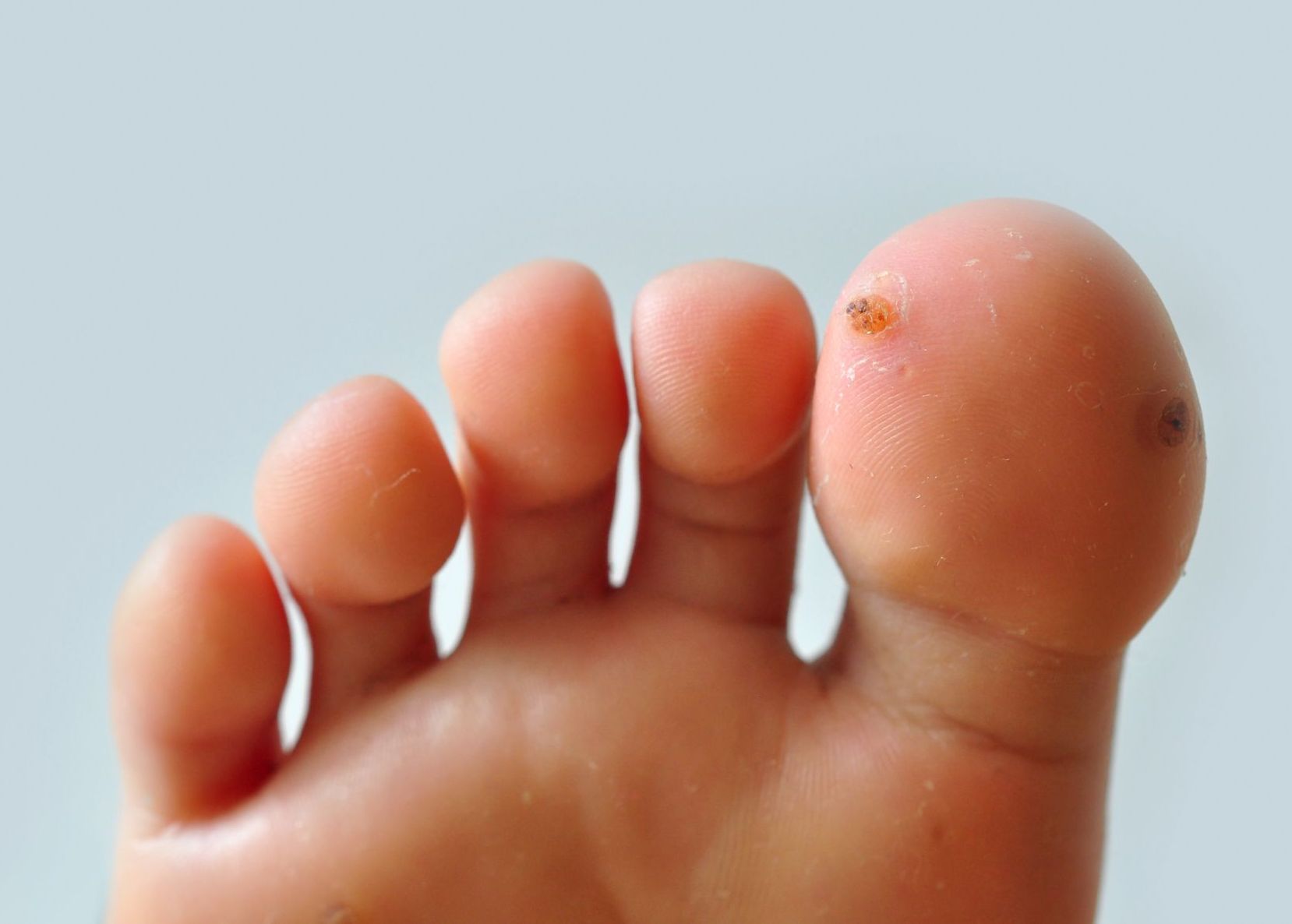 closeup of warts on child patient's foot