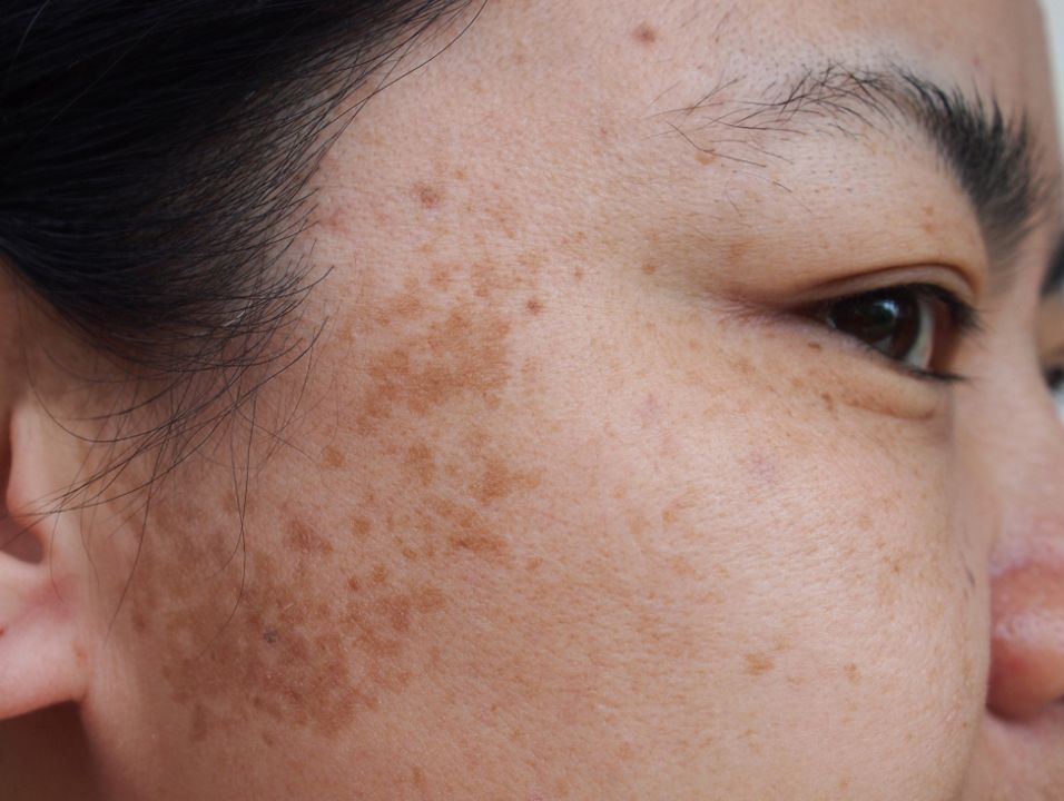 closeup of hyperpigmentation on asian woman's cheek