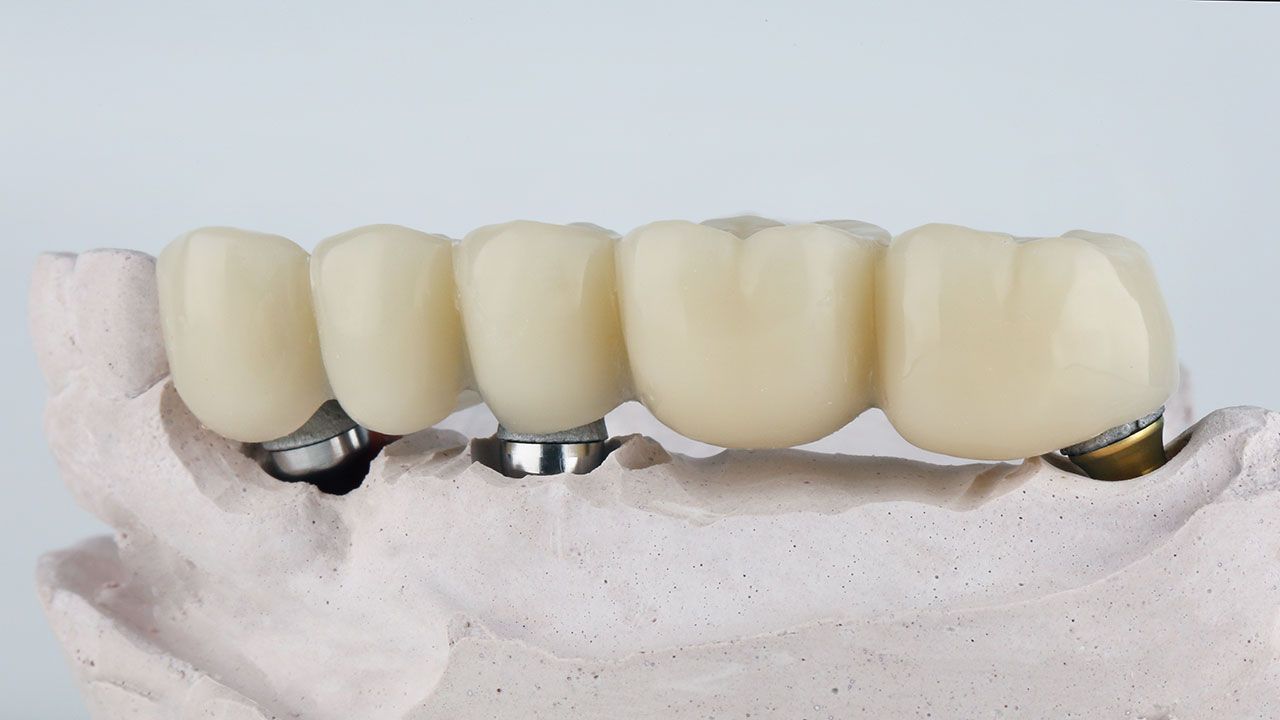 Implant Bridges 101: Replace Several Teeth with Fewer Implants
