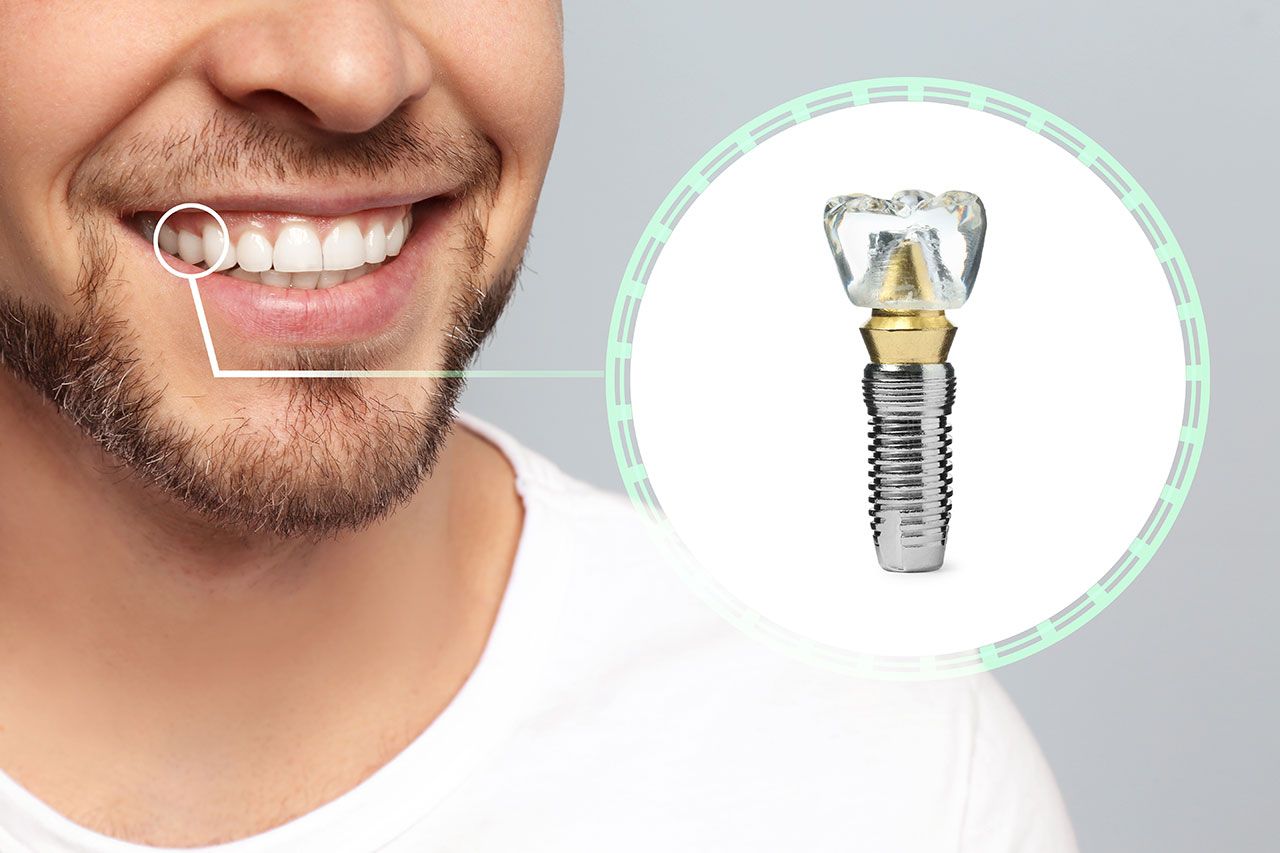 Single-Tooth Implant Crowns