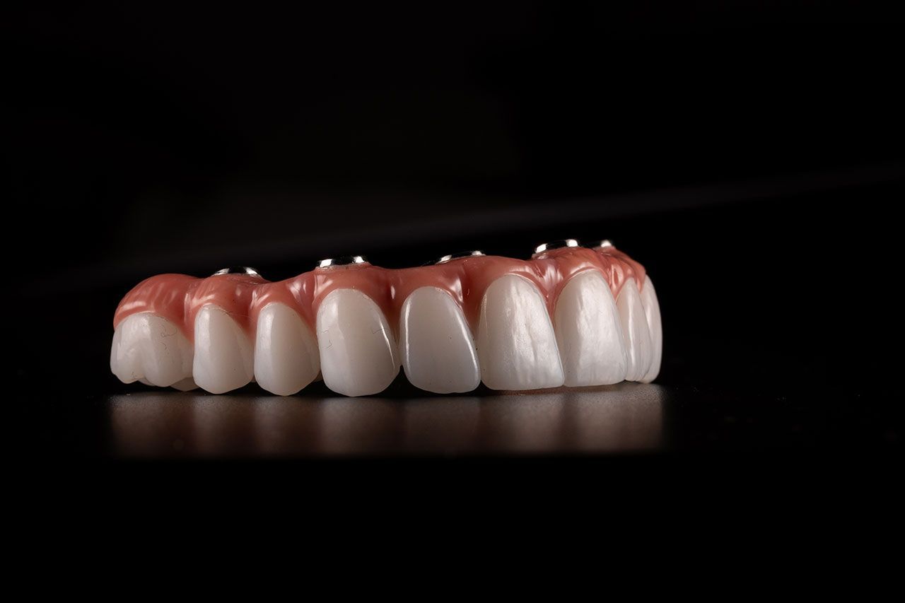 Snap-On Dentures (Overdentures)