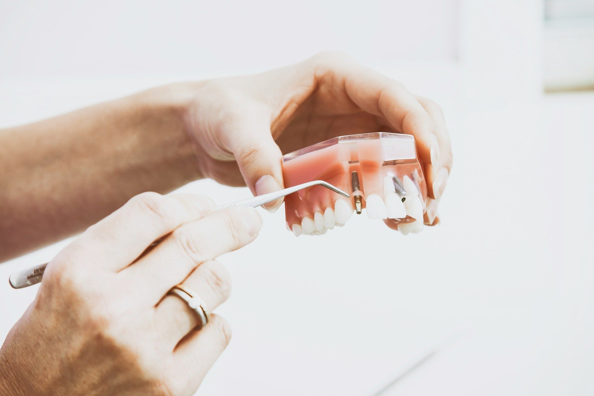 A person is holding a model of a an implant supported denture.