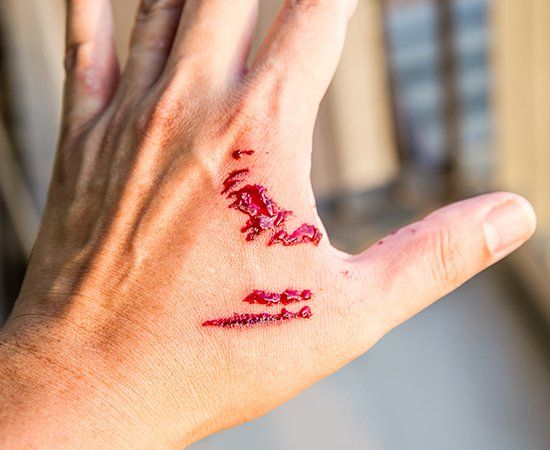 Dog Bite Wound — Decatur, TX — Law Offices of Steven Williams