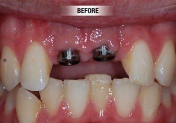 Before Dental Implants — Bunbury WA — FADC Dental Group