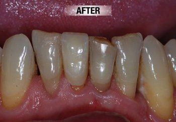 After Restorative Treatment — Bunbury WA — FADC Dental Group
