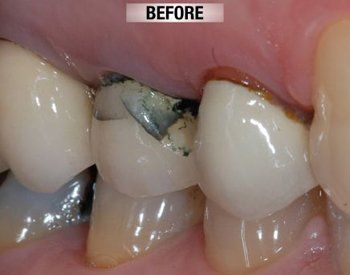 Before Cosmetic Crown Lower Front Tooth — Bunbury WA — FADC Dental Group