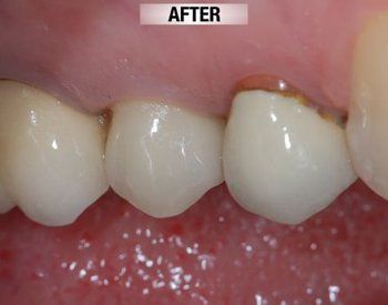 After Cosmetic Crown Lower Front Tooth — Bunbury WA — FADC Dental Group