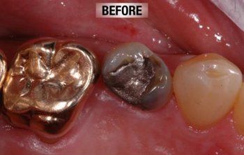 Before Restoration of Worn Down Teeth — Bunbury WA — FADC Dental Group