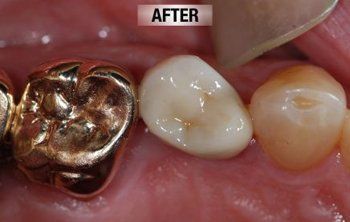 After Restoration of Worn Down Teeth — Bunbury WA — FADC Dental Group