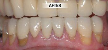 After Restoration of Worn Down Teeth — Bunbury WA — FADC Dental Group
