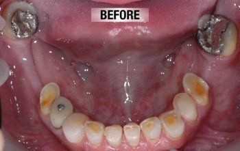 Before Replacing Broken Old Crown — Bunbury WA — FADC Dental Group