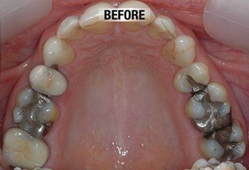 Before Restoration of Worn Down Lower Teeth — Bunbury WA — FADC Dental Group