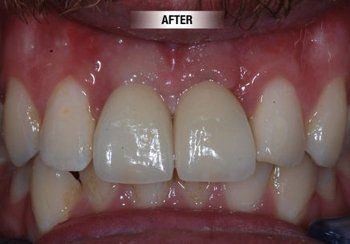 After Dental Implants — Bunbury WA — FADC Dental Group