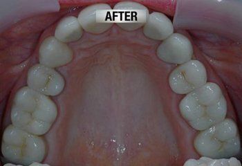 After Restoration of Worn Down Lower Teeth — Bunbury WA — FADC Dental Group