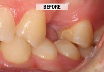 Before Surgery and Prosthetics — Bunbury WA — FADC Dental Group