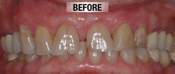 Before Cosmetic Crown — Bunbury WA — FADC Dental Group