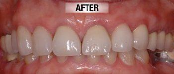 After Cosmetic Crown — Bunbury WA — FADC Dental Group