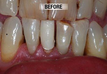 Before Restorative Treatment — Bunbury WA — FADC Dental Group