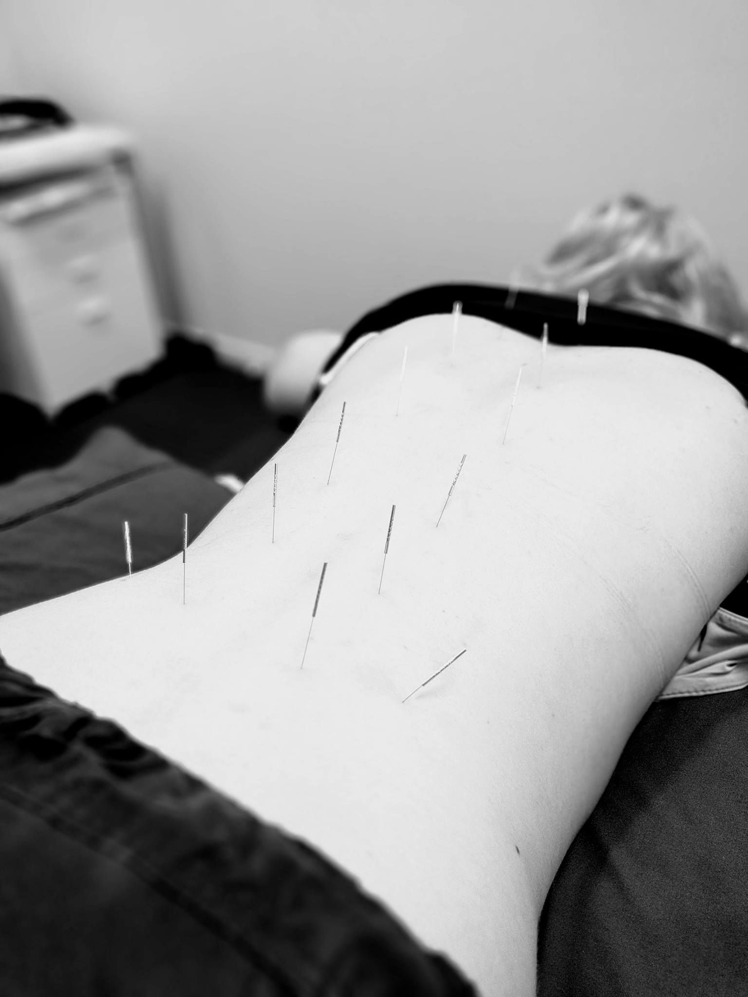 A black and white photo of a person getting acupuncture on their back