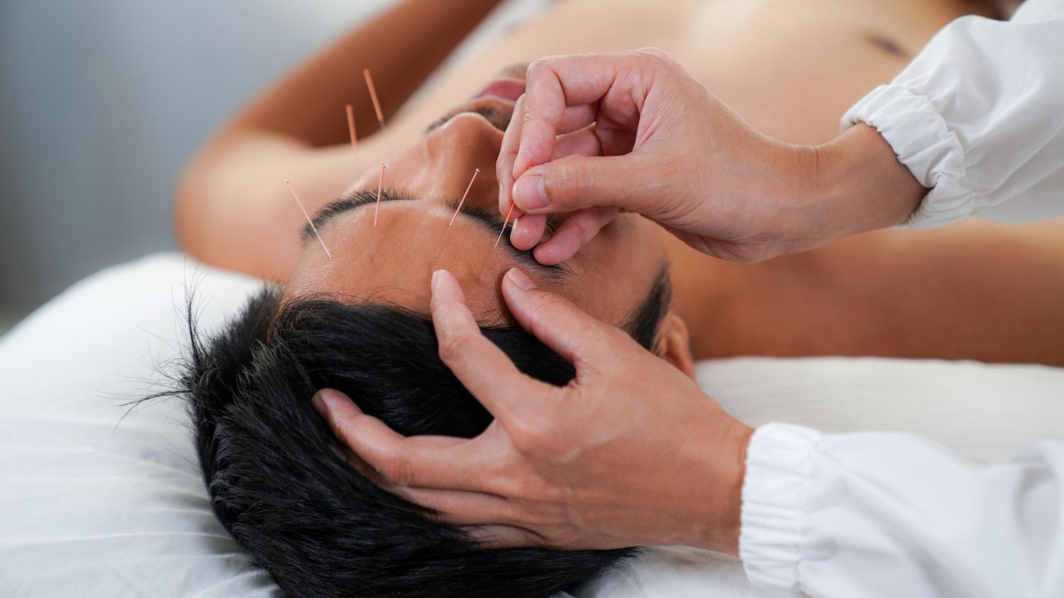 Person receiving acupuncture treatment on their forehead. Needles in place, hands guiding needles.