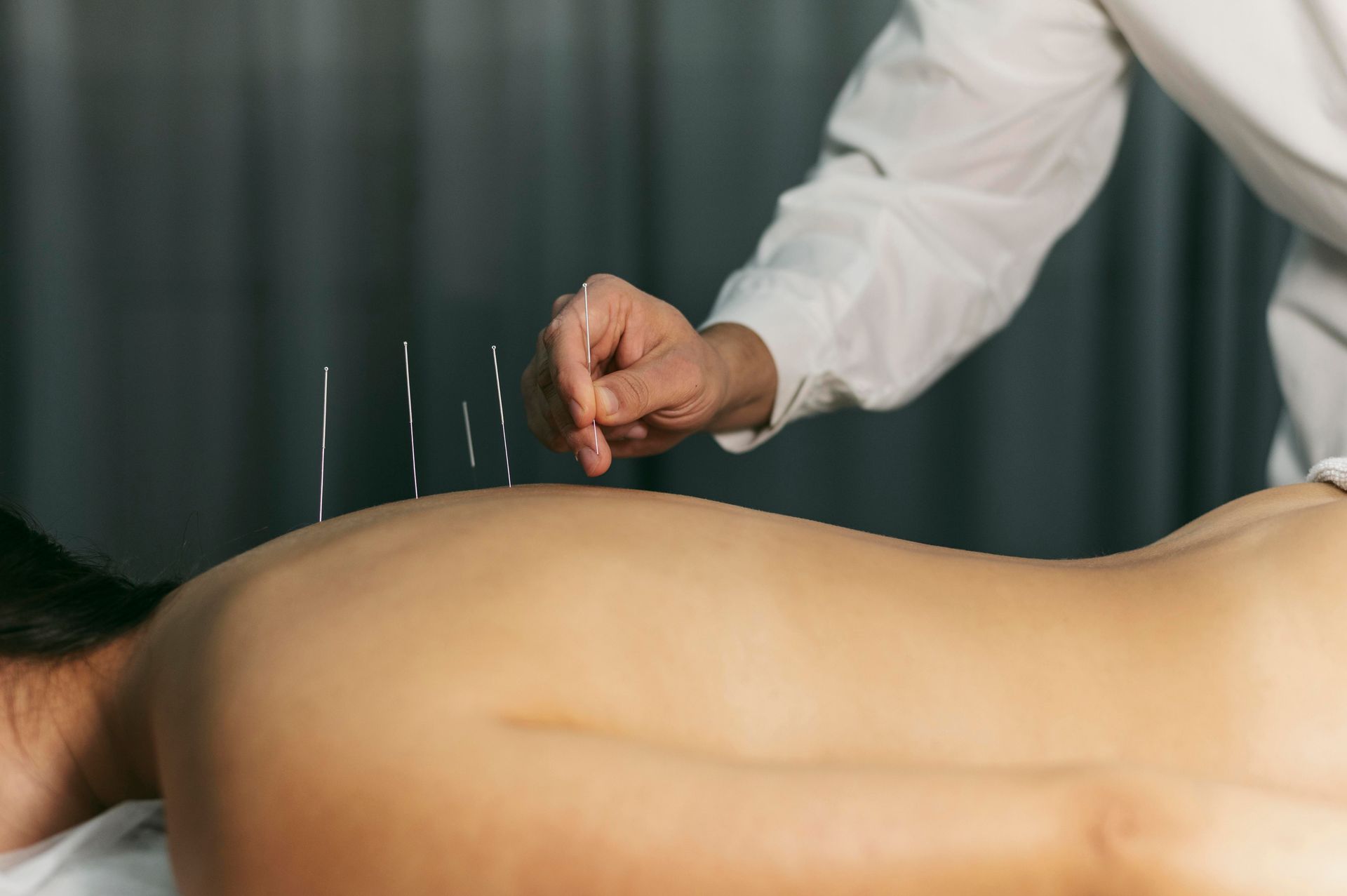 A woman is getting acupuncture on her back by a doctor.