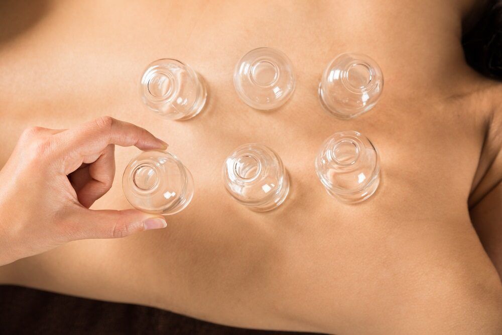 A Woman is Getting a Cupping Treatment on Her Back — Nancy's Traditional Thai Massage In Sunshine Coast, QLD