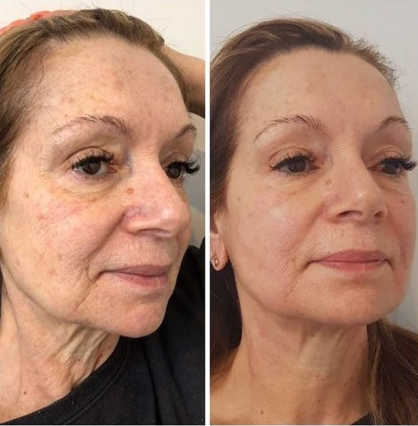 hifu ultrasound before vs after