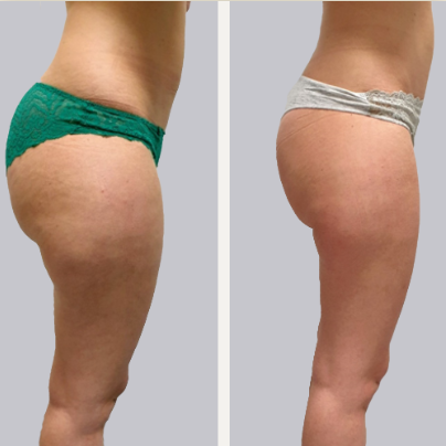 a woman is getting her eyebrows tattooed by a person wearing black gloves