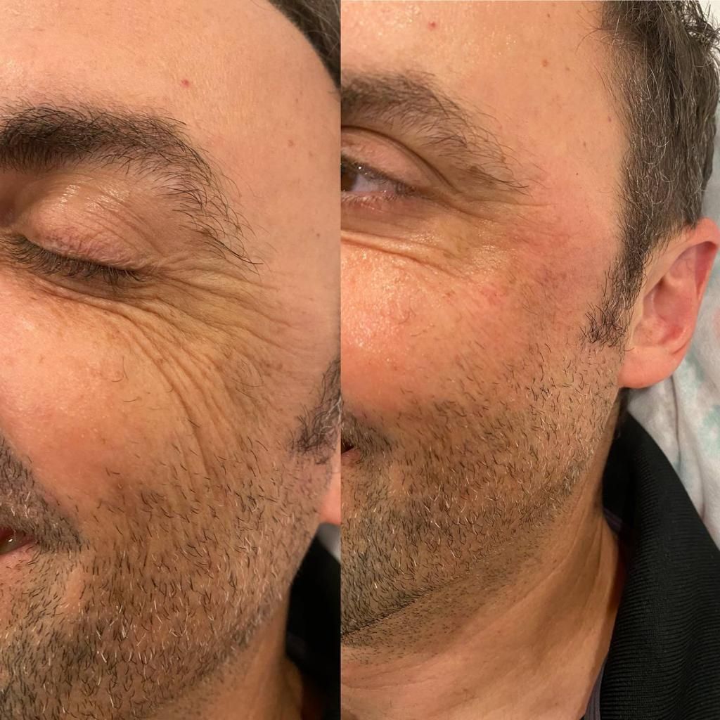 botox before vs after
