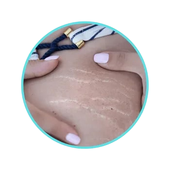 Stretch Mark Camouflage treatment on abdomen in Pittsburgh by Effortless Beauty PGH.