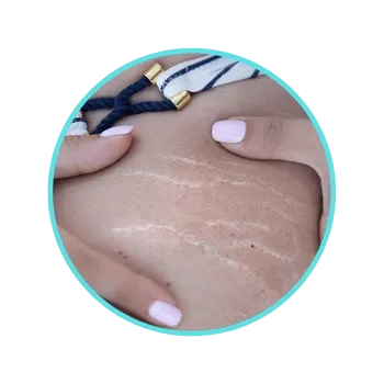 Stretch marks on a woman's abdomen