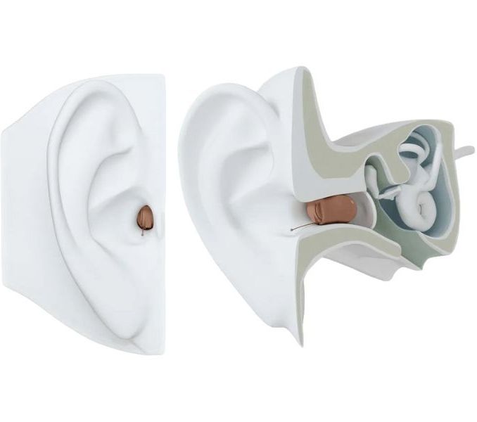 ReSound Invisible In the Ear Canal (IIC) Hearnig Aid